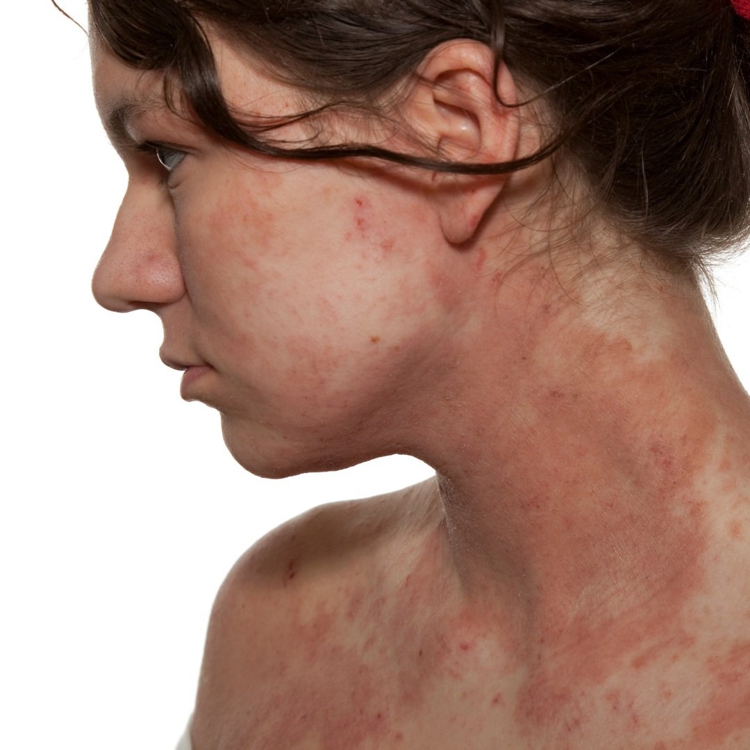 10 ways to holistically ease Eczema