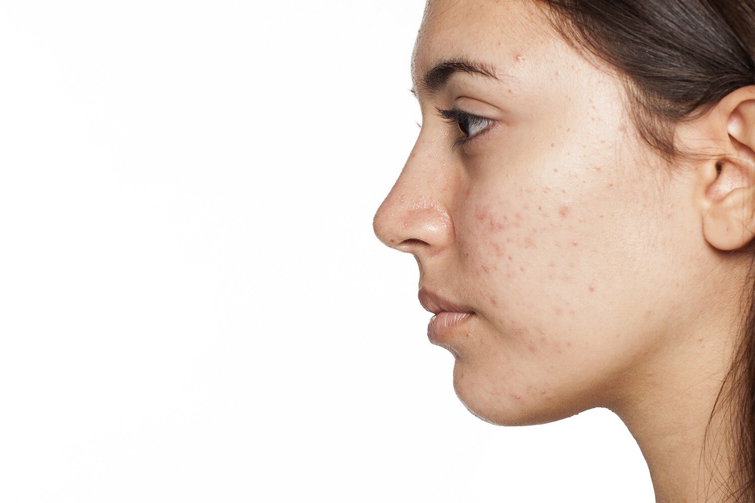 What Causes Post-Pill Acne?