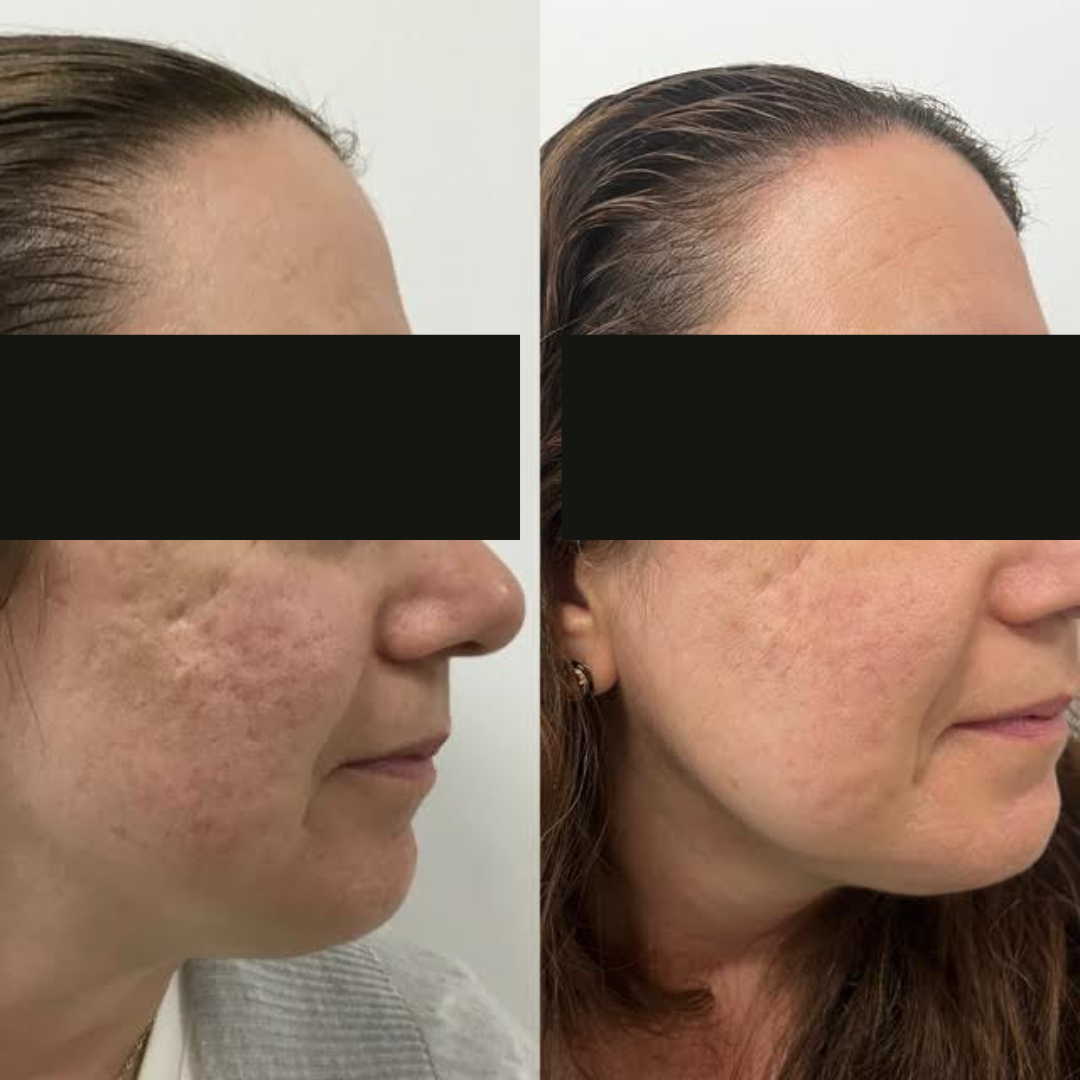 Microneedling & Insulin Therapy in Canberra | Skin Renewal