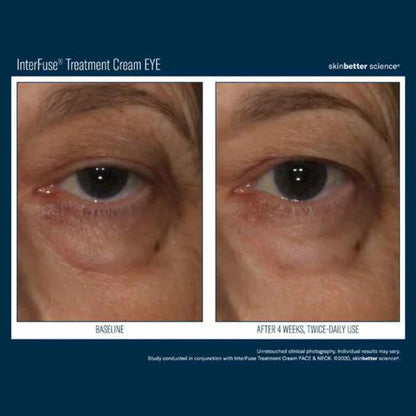 Interfuse Treatment Cream EYE 15ml